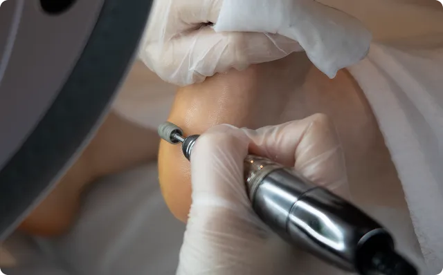 角質・魚の目ケア